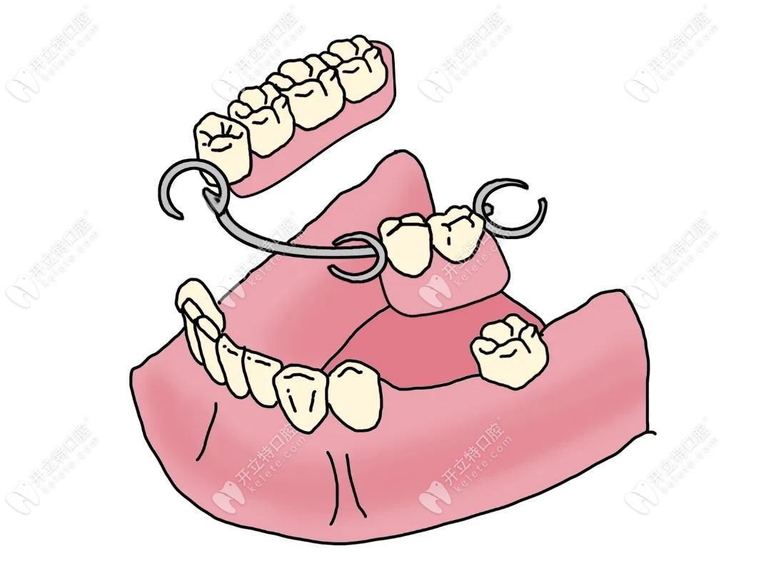 牙槽骨较重萎缩安满口假牙的优势，.kelete.com