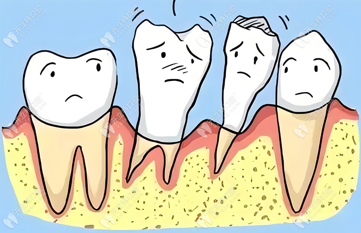 牙周炎牙龈萎缩牙齿松动的针对性治疗