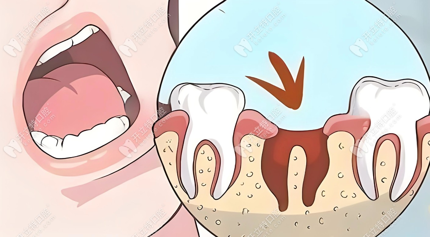 牙槽症是什么原因导致？kelete.com