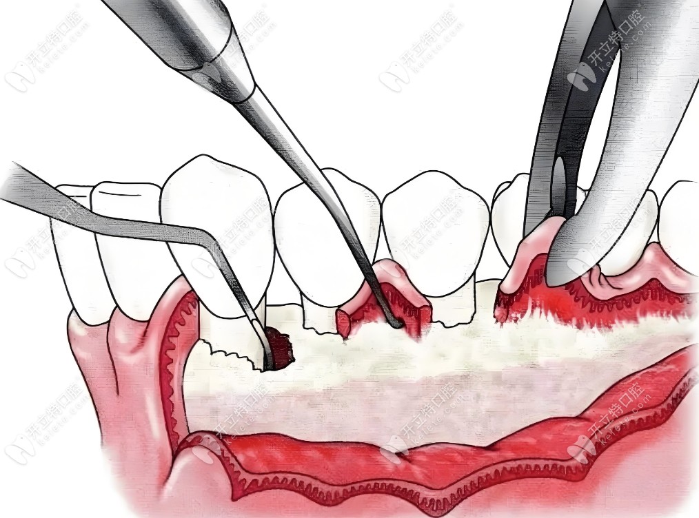 牙龈萎缩牙根外露手术治疗方法——牙龈移植术