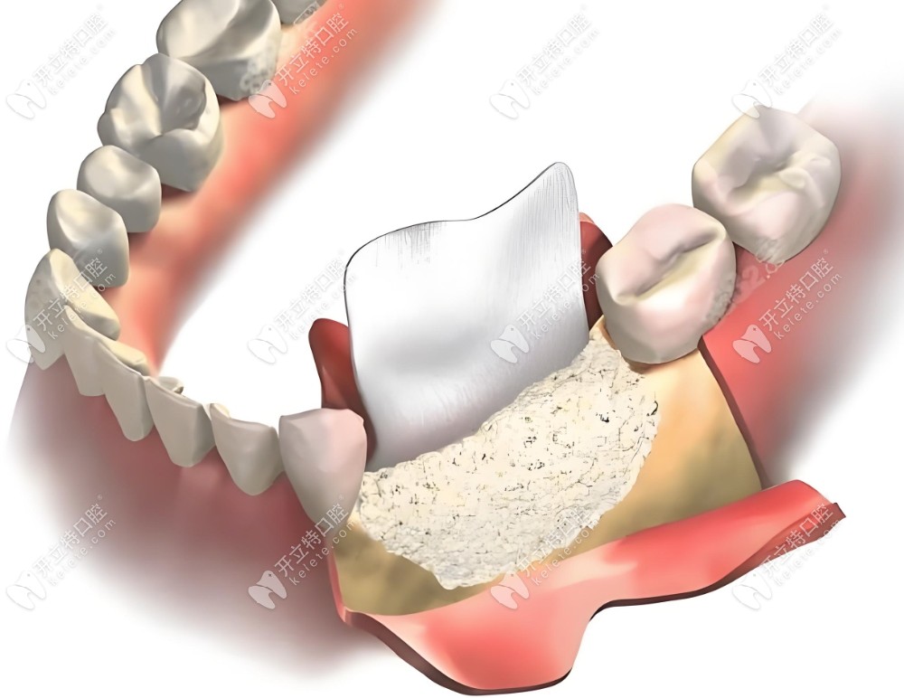 牙龈萎缩牙根外露手术治疗方法——引导组织再生术(GTR)