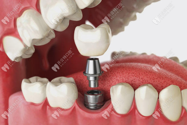 重庆团圆口腔医院种植牙种一颗送一颗是真的吗