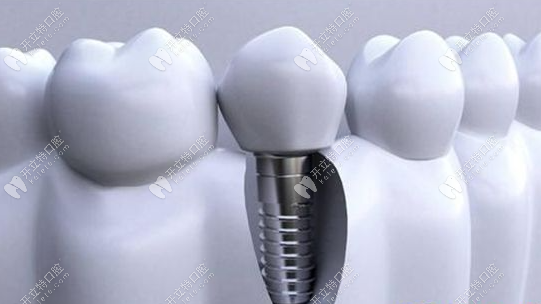 种植牙四级钛五级钛区别