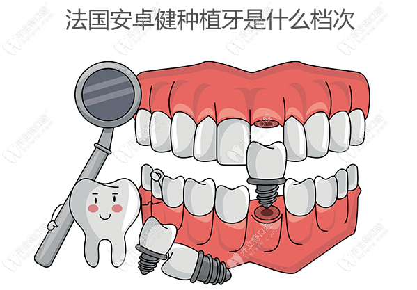 法国安卓健种植牙是什么档次