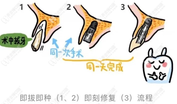 即刻种植与即刻负重操作时机