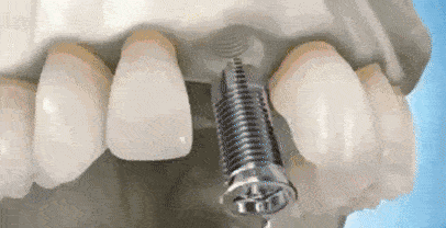 青岛平度齿康口腔种植牙技术