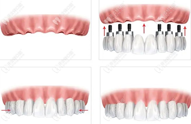奥齿泰种植牙一次性到位