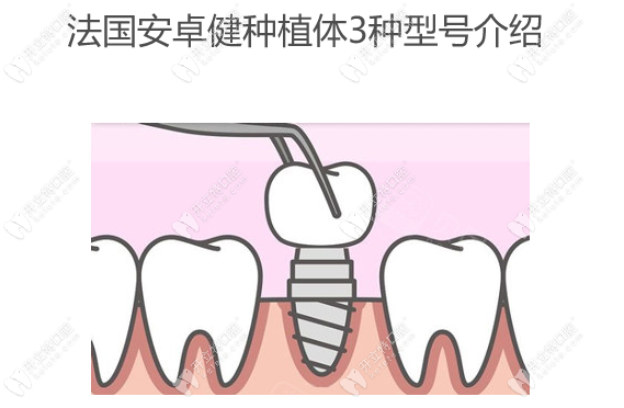 法国安卓健种植体3种型号