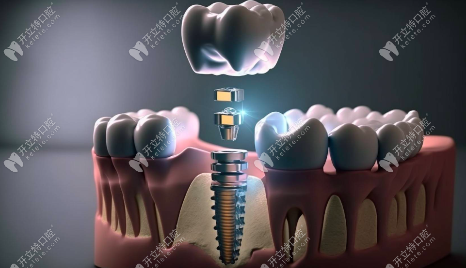 種牙親水和非親水區(qū)別