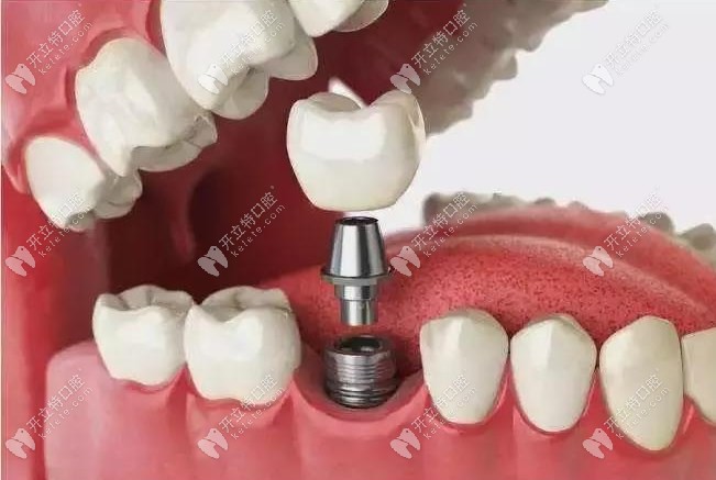 諾貝爾和ITI種植牙哪個(gè)貴