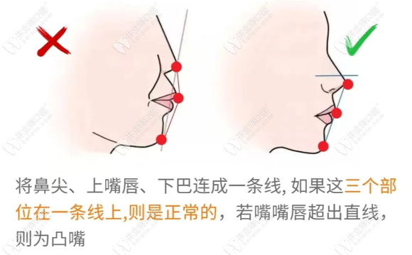 如何判断深覆合是骨性还是牙性？