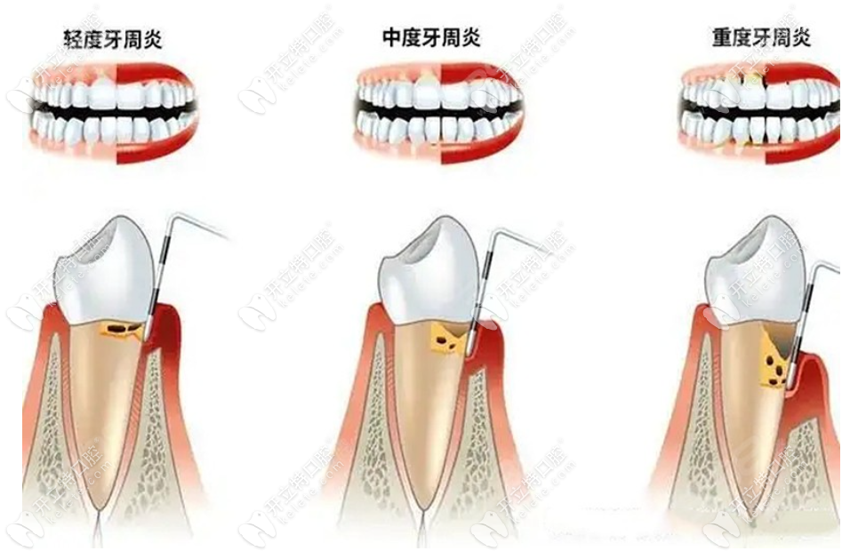 回顾自己的牙周炎经历，我深感痛惜和懊悔