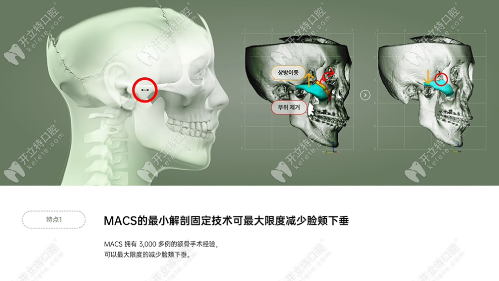 MACS的顴骨手術(shù)操作過程