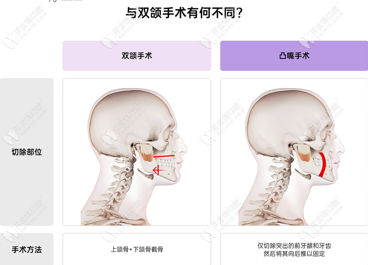 雙頜手術(shù)和凸嘴手術(shù)區(qū)別