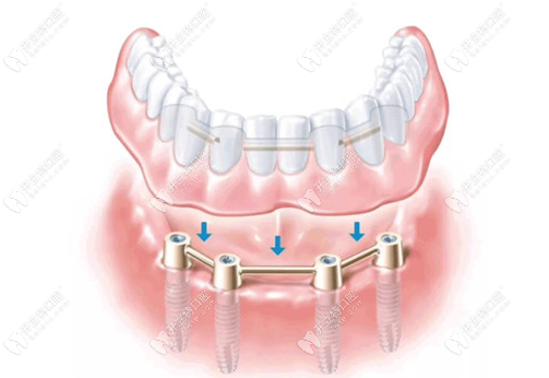老年人裝假牙好還是種植牙好？