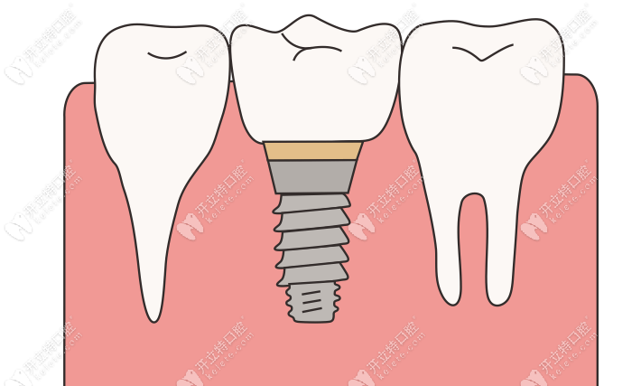 60歲以上種牙有優(yōu)惠政策嗎？