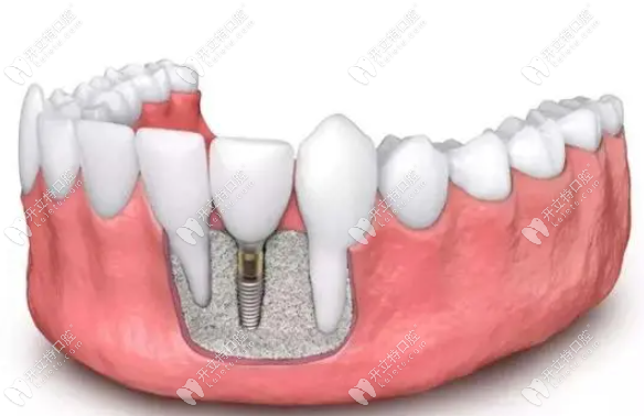 达州绮云口腔单颗种牙价格在2980元起一颗