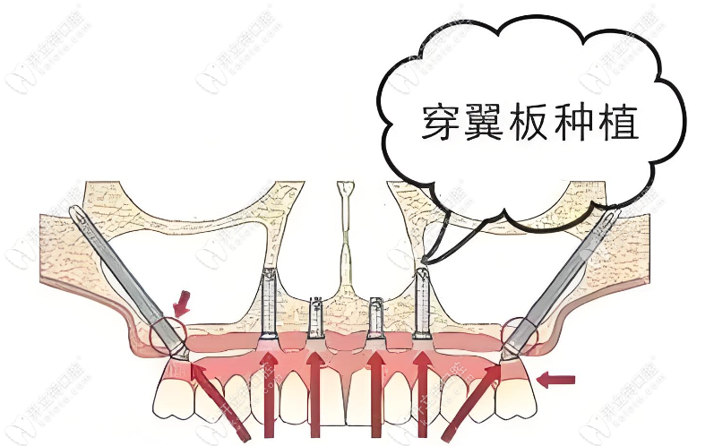 勾洪良醫(yī)生穿顴種植技術靠譜