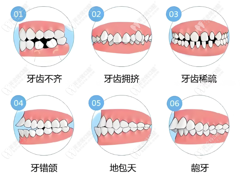 牙齿矫正类型