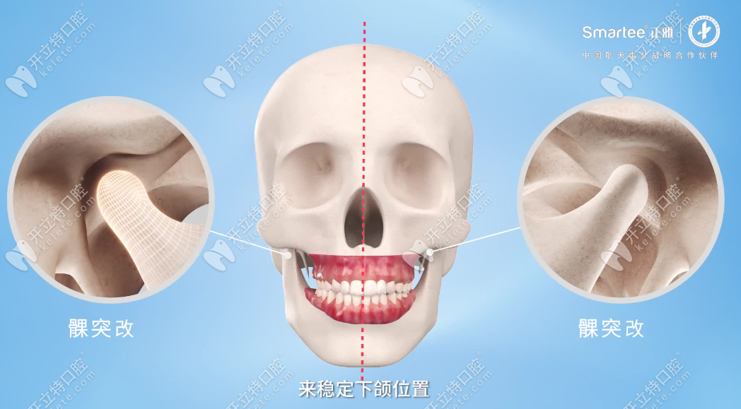 正雅颌位重建技术kelete.com