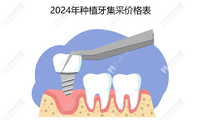 2024年种植牙集采价格