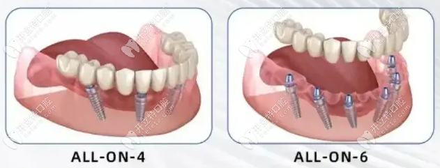 成都All-on-4种植牙价格4万-10万元起