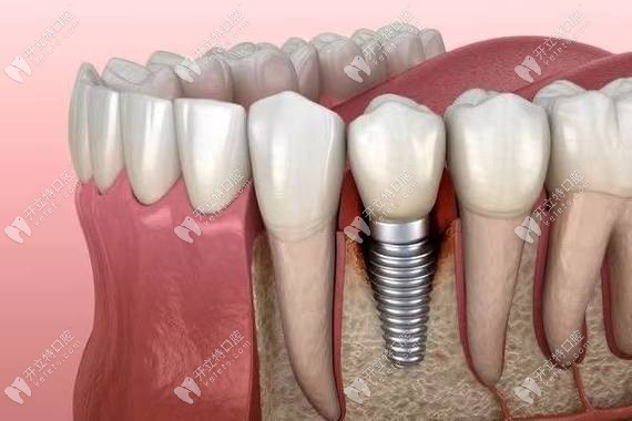 种植牙结构示意图