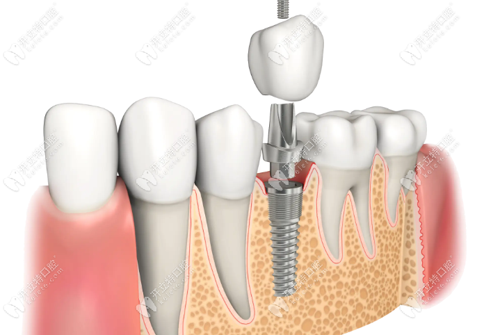 岳阳口腔医院种植牙价格立减1K