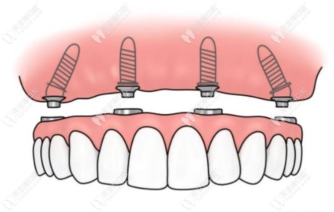 全口半口即刻种植牙