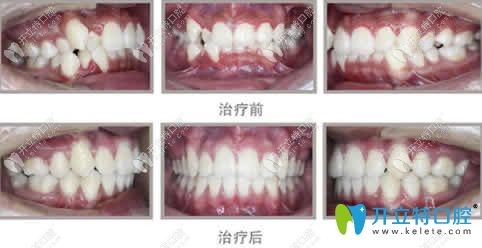 牙齒擁擠不齊拔牙后矯正前后對比圖