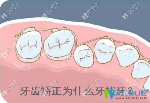 牙齒矯正為什么要拔牙