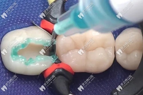二次补牙对牙伤害大吗