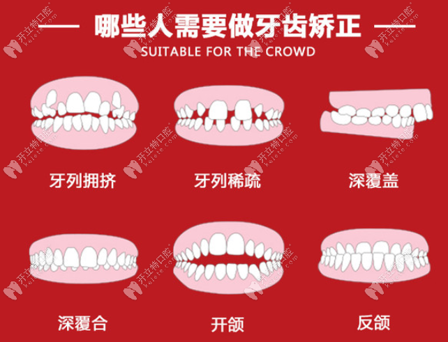 福州登特口腔醫(yī)院矯正牙齒