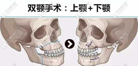正頜手術