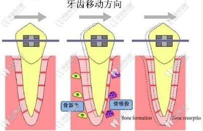 正畸牙齒移動