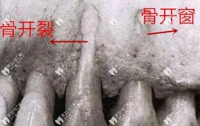 骨開窗和骨開裂示意圖