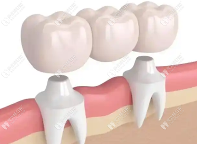 冠修復(fù)牙套VS其他缺牙修復(fù)方式