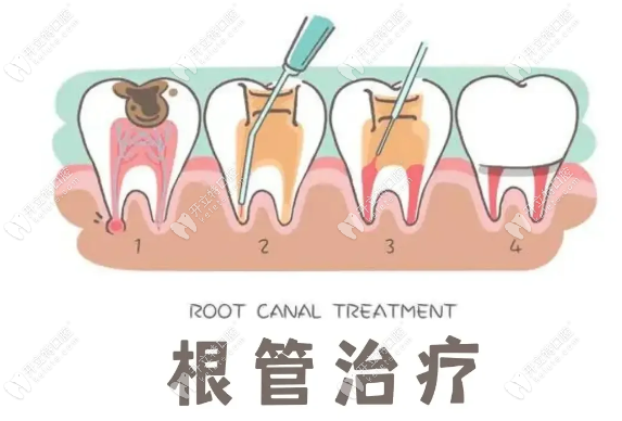 龍巖根管治療價格