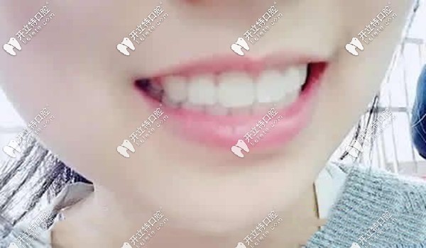 穗江口腔小姐姐矫正后的效果