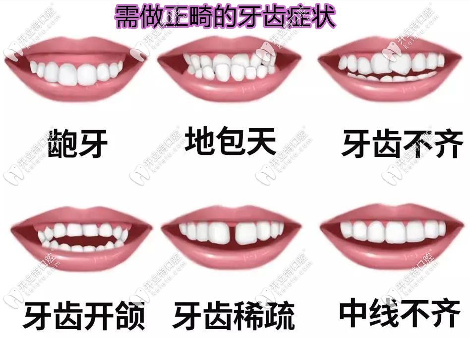 需做正畸的牙齿症状