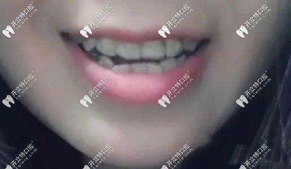 广州穗江口腔小姐姐矫正前的样子