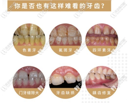 國產(chǎn)全瓷牙適應(yīng)癥都有哪些