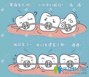 矯正牙齒的矯治器