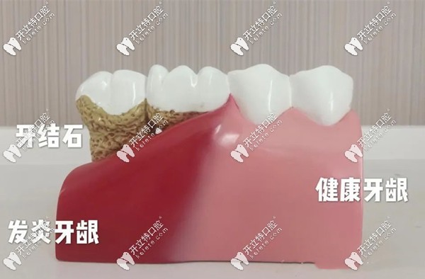 洗牙是維護(hù)牙齒健康的有效方法