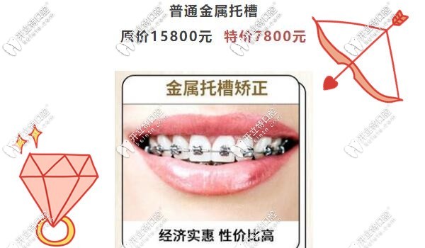 廣州圣貝口腔金屬矯正活動(dòng)價(jià)