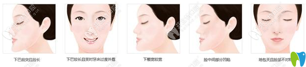 地包天的恢復(fù)過程