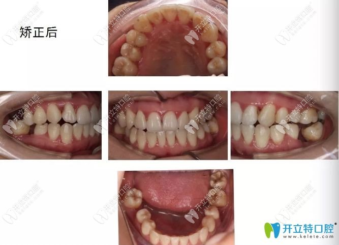 經(jīng)過15月矯正后的<span style=