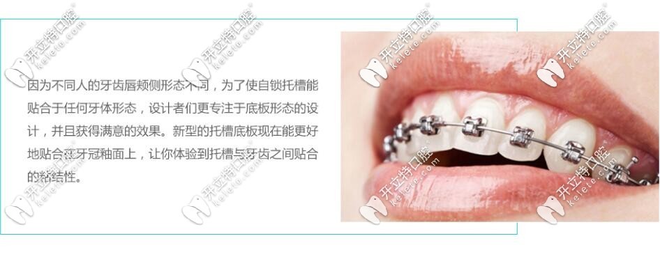 金屬自鎖托槽矯正