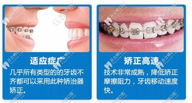 金属矫正的优势