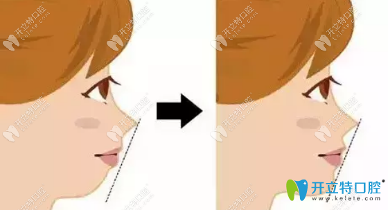 判斷孩子的面型，看是否需要做牙齒矯正